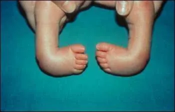 Lorsque vous avez une malformation congénitale du pied, vous avez un...