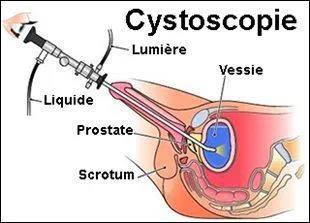 Quel est cet examen qu'on appelle cystoscopie ?