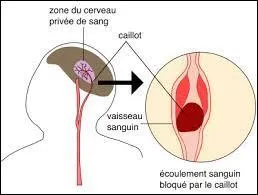 De quoi est-il mort ?