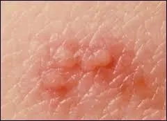 Quelle maladie se manifeste par des éruptions cutanées douloureuses le long d'un nerf ?