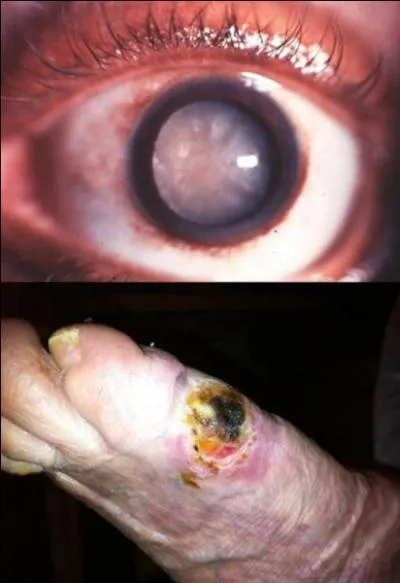 Le diabète peut provoquer des affections graves dans la vie d'un malade. 
Serez-vous capable de trouver ces affections, ces conséquences ?