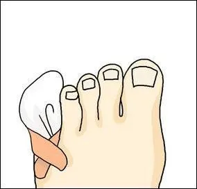 "En montant en bas, Julie s'est retourné le petit orteil du pied sur la dernière marche".
Combien y a-t-il de pléonasmes ou de précisions inutiles dans cette phrase ?