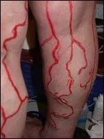 Le phlébologue soigne ... .