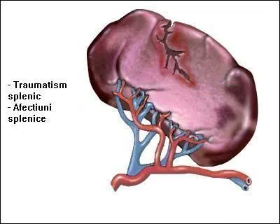 Une gastrectomie est à l'estomac ce qu'une splénectomie est ... .