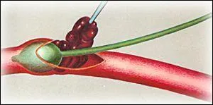 Complétez : " Les médecins ont retiré le caillot qui ... l'artère.