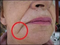 Et comment s'appelle cette ride qui apparaît parfois au "coin" des lèvres ?