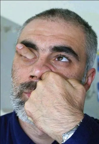 Lorsque vous vous mettez le doigt dans l'oeil, c'est que...