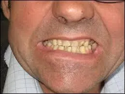 Lorsque je suis atteint de bruxisme, mes dents peuvent grincer jusqu'à :