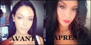 Nabilla a-t-elle fait de la chirurgie esthétique ?