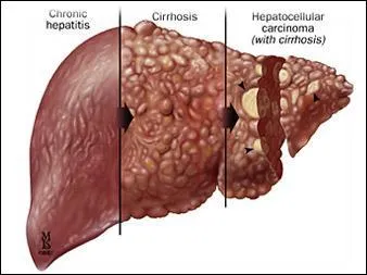Parmi ces 3 maladies, laquelle n'est pas sexuellement transmissible ?