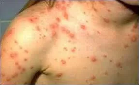 Comment est transmise la bactérie qui cause le typhus ?