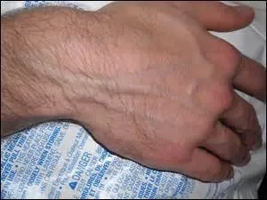 Pourquoi les veines sont-elles bleues ?