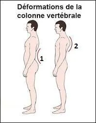 La lordose porte le n° 1 et la cyphose le n° 2. (cf.photo)