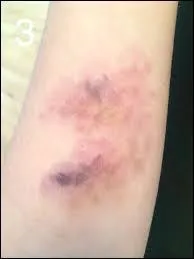 Une « écchymose » : le mot est bien orthographié.