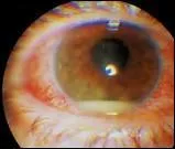 De quoi les yeux d'écrevisse mis en sachet et que vous porterez pendus au cou vous guériront-ils ?