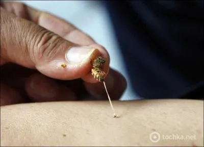 Lorsqu'une abeille vous pique, le dard reste enfoncé dans la plupart des cas et elle en meurt, pour retirer le dard, la meilleure solution est de l'ôter doucement avec les doigts !