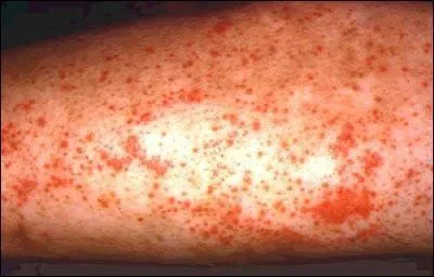 Quelle maladie due à une carence en vitamine PP se manifeste notamment par des lésions cutanées.