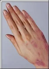 Terme mdical dsignant un syndrome pouvant correspondre  plusieurs maladies de la peau :