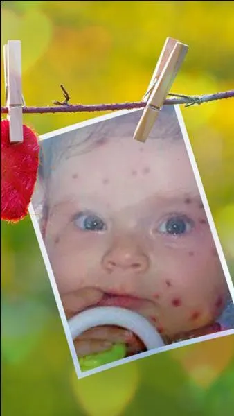 Quelle maladie contagieuse atteint essentiellement les enfants entre 2 et 4 ans, est appelée la "première maladie", et est caractérisée par l'apparition de petites taches rouges en relief ?