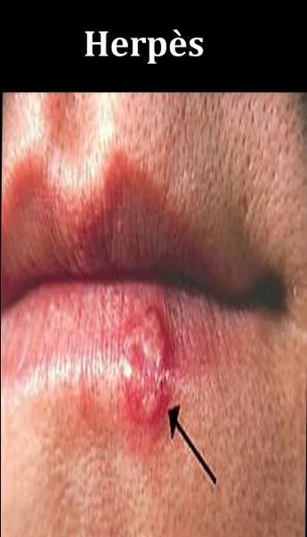 Quelle est la méthode simple et efficace pour prévenir un herpès ?