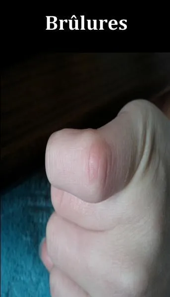 Quel est le bon remède contre les petites brûlures ménagères ?