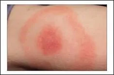 Dès lors que cette bestiole s'accroche à vous, parce qu'elle en veut à votre peau, il est légitime de redouter la maladie de Lyme. Que faut-il pour la soigner si le diagnostic est posé ?