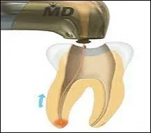 Quel n'est pas le synonyme du verbe obturer ?