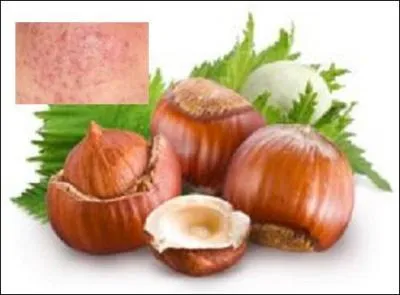 Quel type d'affection, l'huile faite avec la noisette pourrait-elle soigner en réduisant la production de sébum ?