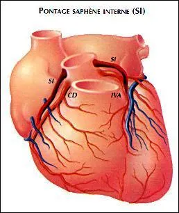 Qu'est-ce qu'une "sténose" ?
