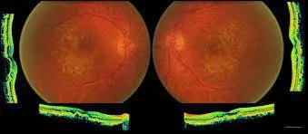 Qu'est-ce qu'une OCT ?