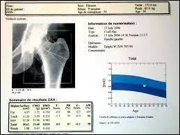 Qu'est-ce qu'une ostéodensitométrie ?