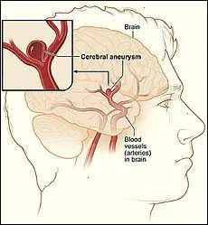 Qu'est-ce qu'une rupture d'anévrisme ?