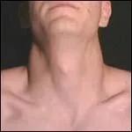 La pomme d'Adam correspond au cartilage thyroïde. Laquelle de ces propositions est-elle vraie ?