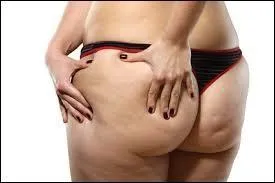 La cellulite, ennemie intime de beaucoup de ces dames, porte également l'appellation courante de :