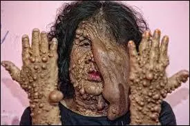 Parmi ces divers problèmes de santé, lequel n'a aucun rapport avec la peau ?