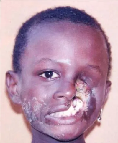 Quelle est cette terrible maladie méconnue, forme de gangrène infectieuse du visage, qui frappe chaque année 6000 enfants de moins de 6 ans dans les pays d'extrême pauvreté ?