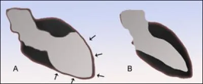 Le syndrome de tako-tsubo, ou encore appelé syndrome des cœurs brisés, est une cardiomyopathie consistant en une sidération myocardique qui survient après :