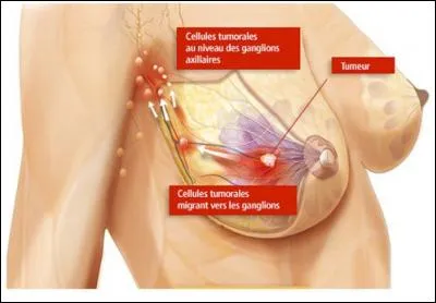 &Agrave; Cr&eacute;teil, un cancer du sein a &eacute;t&eacute; trait&eacute; par radioth&eacute;rapie &agrave; 22 reprises du mauvais c&ocirc;t&eacute;.