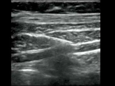 La technique du tap block, consiste en :