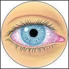 Cette maladie concerne les yeux et se définit par l'inflammation de la couche recouvrant l'œil en temps normal. L'œil est rouge, et on doit parfois porter une paire de lunettes.