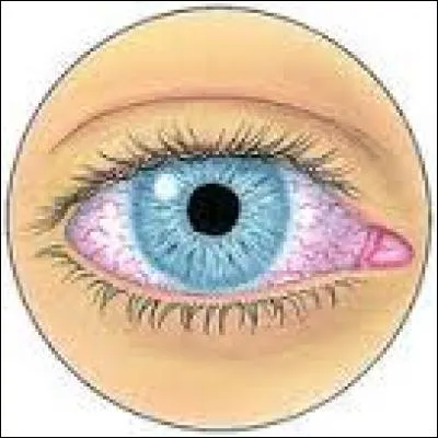 Cette maladie concerne les yeux et se définit par l'inflammation de la couche recouvrant l'il en temps normal. L'il est rouge, et on doit parfois porter une paire de lunettes.