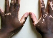 Quiz Le vitiligo