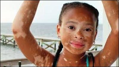 Quelle partie du corps touche le vitiligo ?