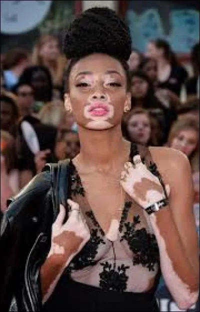 Qu'est-ce que le vitiligo ?