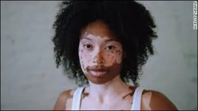 Le vitiligo fait-il mal ?