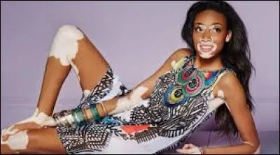 L'évolution du vitiligo est-elle prévisible ?