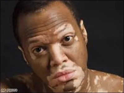 Les personnes atteintes du vitiligo sont-elles sensibles au soleil ?