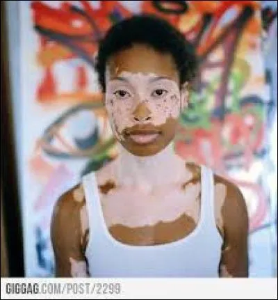 Le vitiligo est-il mortel ?