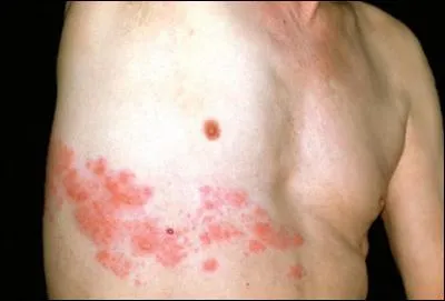 Existe-t-il un vaccin contre le zona ?