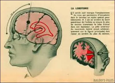 Durant la décennie qui a suivi la Seconde Guerre mondiale, le Dr Walter Freeman pratiqua plus de 3500 lobotomies (section des lobes frontaux du cerveau, afin de "calmer" certains malades mentaux).
